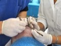 Patient während der Haartransplantation durch die Ärzte