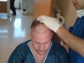 Rasieren für die Haartransplantation