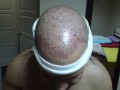 Patient nach der Haartransplantation