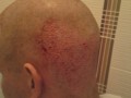 Patient nach der Haartransplantation