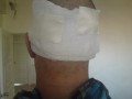 Patient mit Verband nach der Haartransplantation